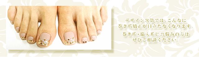 デザイン次第では、こんなに巻き爪矯正が目立たなくなります。